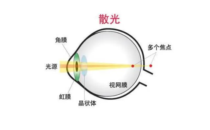 散光200度严重吗